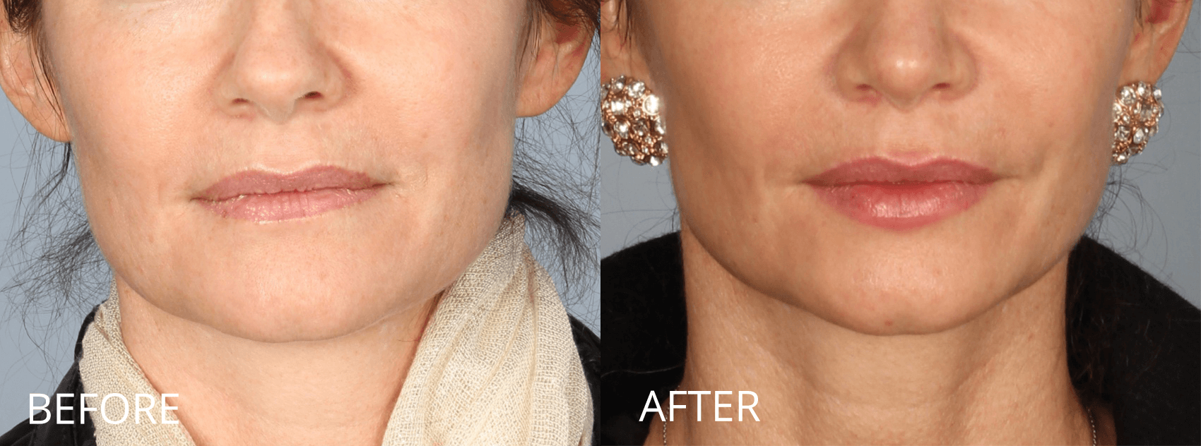 Botox And Fillers Before And Afters Raval Facial Aesthetics Denver